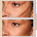 Upper cheek contour result